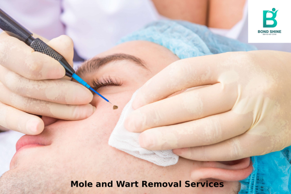 Mole and Wart Removal